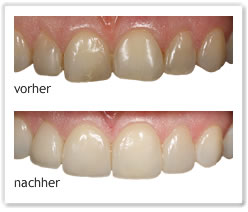 Foto 2  Non-Prep-Veneers vorher/ nachher