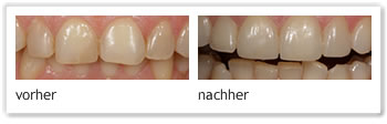 Foto 3 Non-Prep-Veneers vorher/ nachher